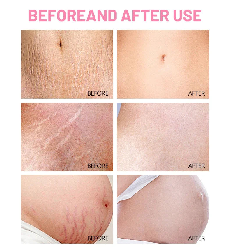 Aceite AntiEstrías DulcePiel™ 💖